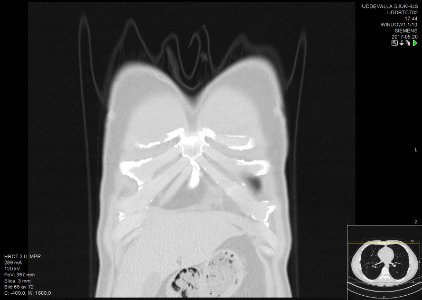 High-resolution computed tomograph of a normal thorax, coronal plane (2)