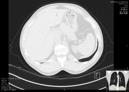 High-resolution computed tomograph of a normal thorax, axial plane (108)