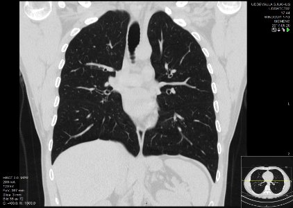 High-resolution computed tomograph of a normal thorax, coronal plane (32)