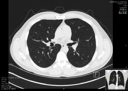 High-resolution computed tomograph of a normal thorax, axial plane (47)