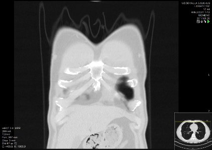 High-resolution computed tomograph of a normal thorax, coronal plane (3)