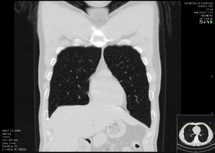 High-resolution computed tomograph of a normal thorax, coronal plane (12)