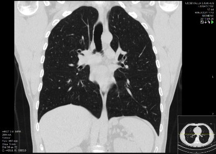 High-resolution computed tomograph of a normal thorax, coronal plane (34)