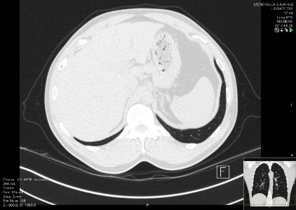 High-resolution computed tomograph of a normal thorax, axial plane (102)