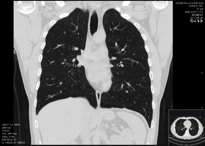 High-resolution computed tomograph of a normal thorax, coronal plane (31)