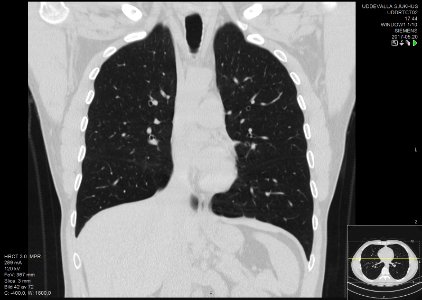 High-resolution computed tomograph of a normal thorax, coronal plane (28)