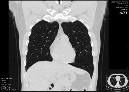 High-resolution computed tomograph of a normal thorax, coronal plane (18)