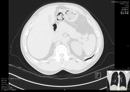 High-resolution computed tomograph of a normal thorax, axial plane (113)