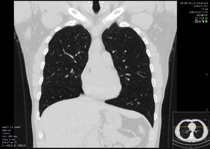 High-resolution computed tomograph of a normal thorax, coronal plane (23)