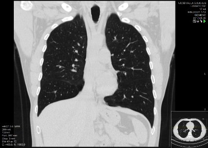 High-resolution computed tomograph of a normal thorax, coronal plane (27)