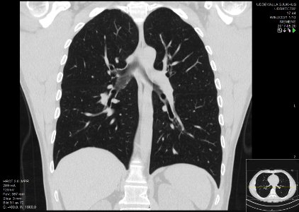 High-resolution computed tomograph of a normal thorax, coronal plane (39)