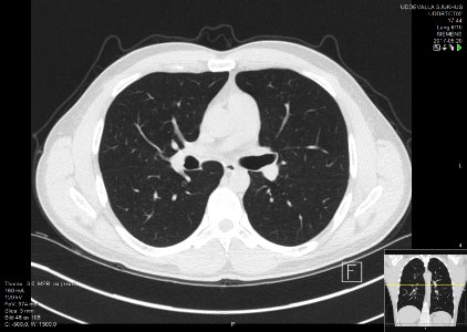 High-resolution computed tomograph of a normal thorax, axial plane (46)