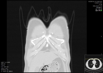 High-resolution computed tomograph of a normal thorax, coronal plane (1)