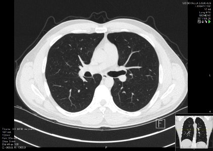 High-resolution computed tomograph of a normal thorax, axial plane (45)