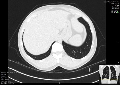 High-resolution computed tomograph of a normal thorax, axial plane (94)