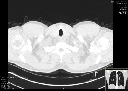 High-resolution computed tomograph of a normal thorax, axial plane (3)