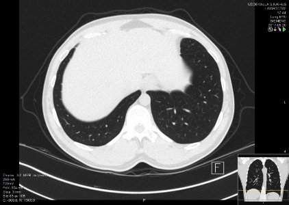 High-resolution computed tomograph of a normal thorax, axial plane (86)