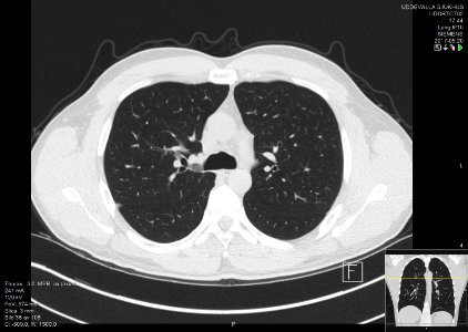 High-resolution computed tomograph of a normal thorax, axial plane (36)