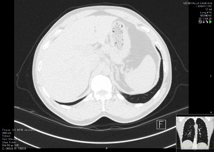 High-resolution computed tomograph of a normal thorax, axial plane (103)