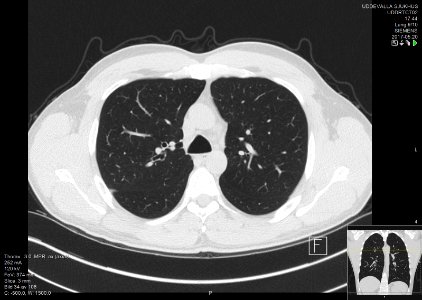 High-resolution computed tomograph of a normal thorax, axial plane (34)