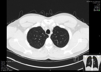 High-resolution computed tomograph of a normal thorax, axial plane (18)