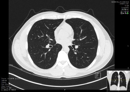High-resolution computed tomograph of a normal thorax, axial plane (51)
