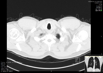 High-resolution computed tomograph of a normal thorax, axial plane (4)