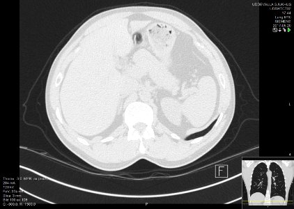 High-resolution computed tomograph of a normal thorax, axial plane (110)