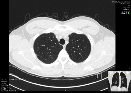 High-resolution computed tomograph of a normal thorax, axial plane (20)