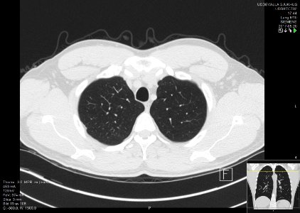 High-resolution computed tomograph of a normal thorax, axial plane (19)