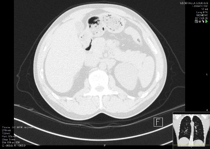 High-resolution computed tomograph of a normal thorax, axial plane (117)