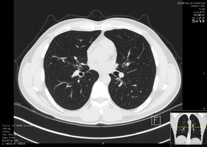 High-resolution computed tomograph of a normal thorax, axial plane (50)