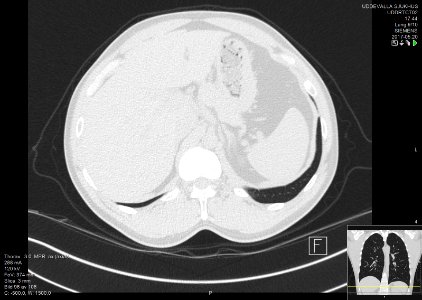 High-resolution computed tomograph of a normal thorax, axial plane (105)