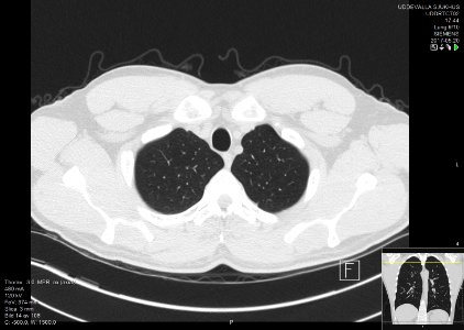 High-resolution computed tomograph of a normal thorax, axial plane (14)