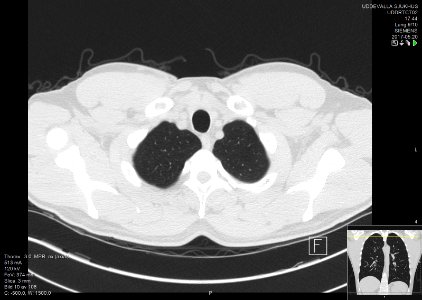 High-resolution computed tomograph of a normal thorax, axial plane (10)