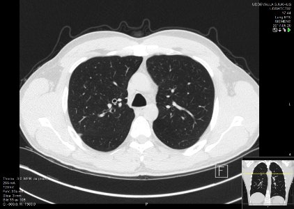 High-resolution computed tomograph of a normal thorax, axial plane (33)