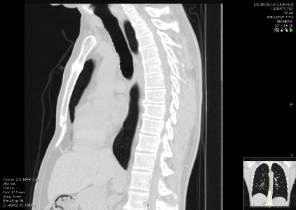 High-resolution computed tomograph of a normal thorax, sagittal plane (48)