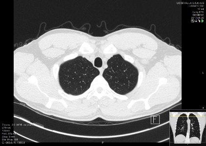 High-resolution computed tomograph of a normal thorax, axial plane (15)