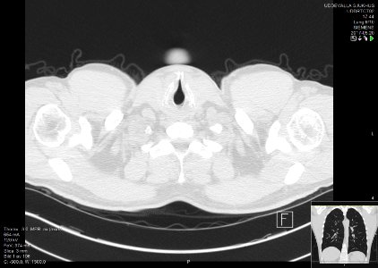 High-resolution computed tomograph of a normal thorax, axial plane (1)