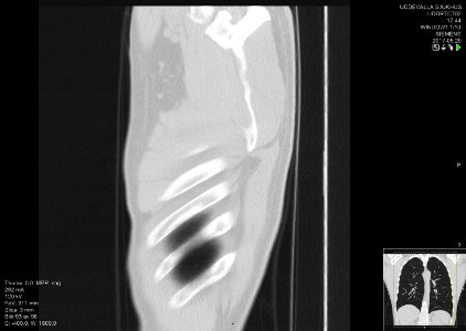 High-resolution computed tomograph of a normal thorax, sagittal plane (93)