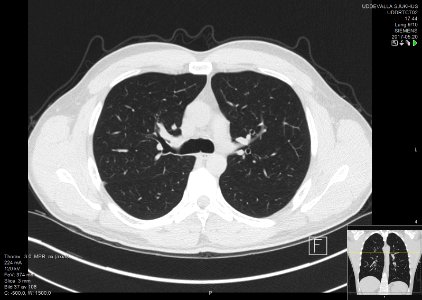High-resolution computed tomograph of a normal thorax, axial plane (37)