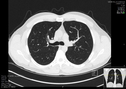 High-resolution computed tomograph of a normal thorax, axial plane (38)