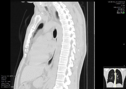 High-resolution computed tomograph of a normal thorax, sagittal plane (52)