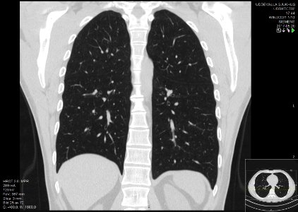 High-resolution computed tomograph of a normal thorax, coronal plane (45)