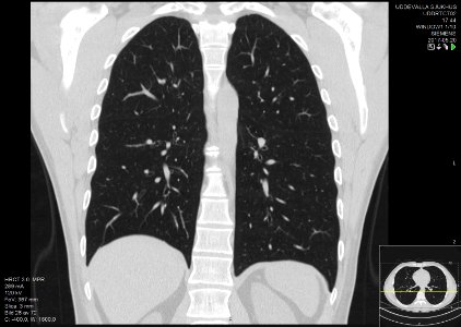 High-resolution computed tomograph of a normal thorax, coronal plane (44)