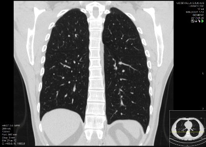 High-resolution computed tomograph of a normal thorax, coronal plane (47)
