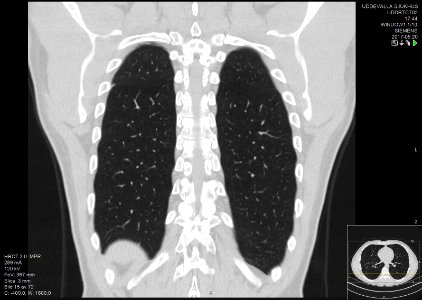 High-resolution computed tomograph of a normal thorax, coronal plane (55)