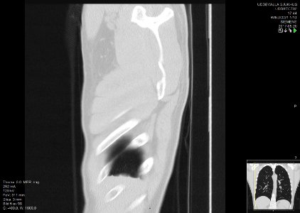 High-resolution computed tomograph of a normal thorax, sagittal plane (5)