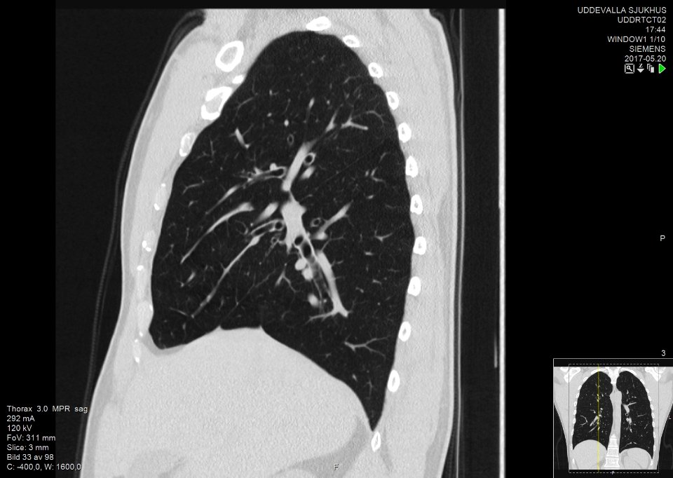 High-resolution computed tomograph of a normal thorax, sagittal plane (33)