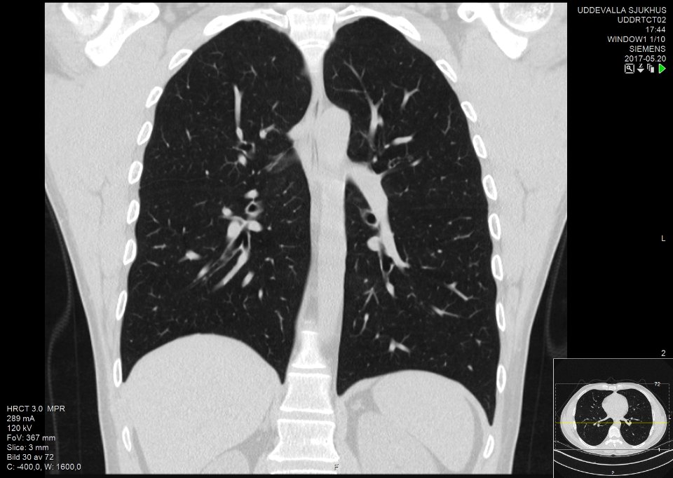 High-resolution computed tomograph of a normal thorax, coronal plane (40)